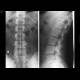Spondylolysis, lumbar vertebra: X-ray - Plain radiograph